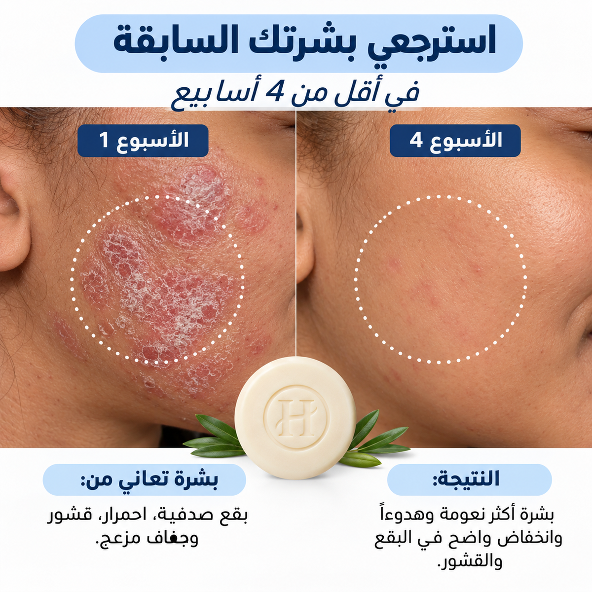 Voted No. 1 in France for Psoriasis