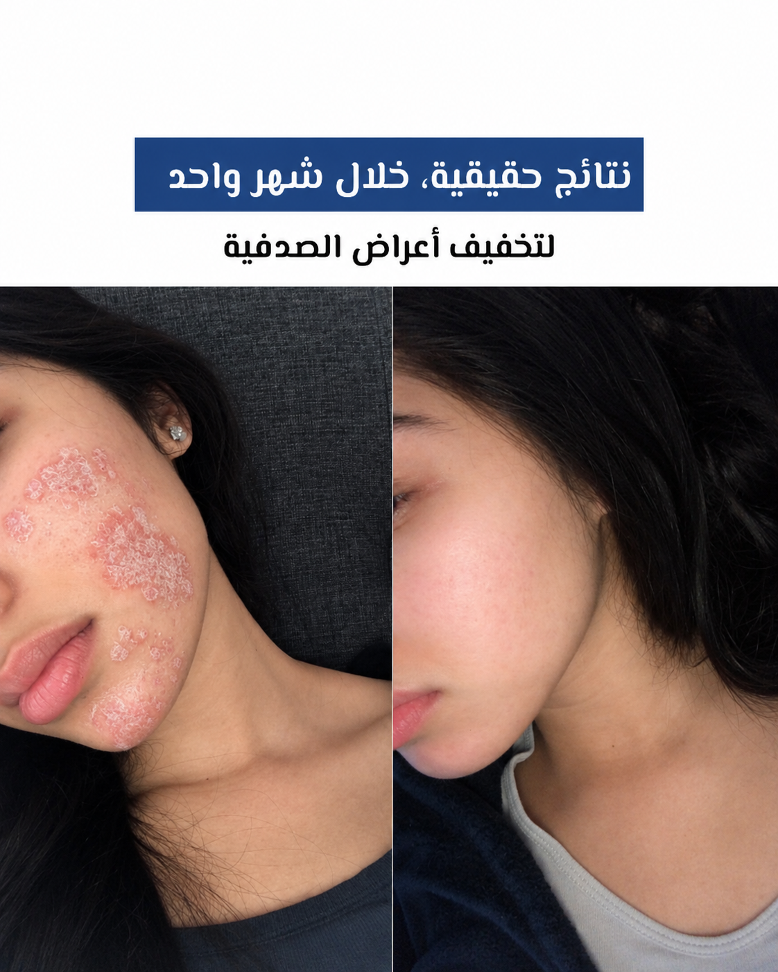 Voted No. 1 in France for Psoriasis
