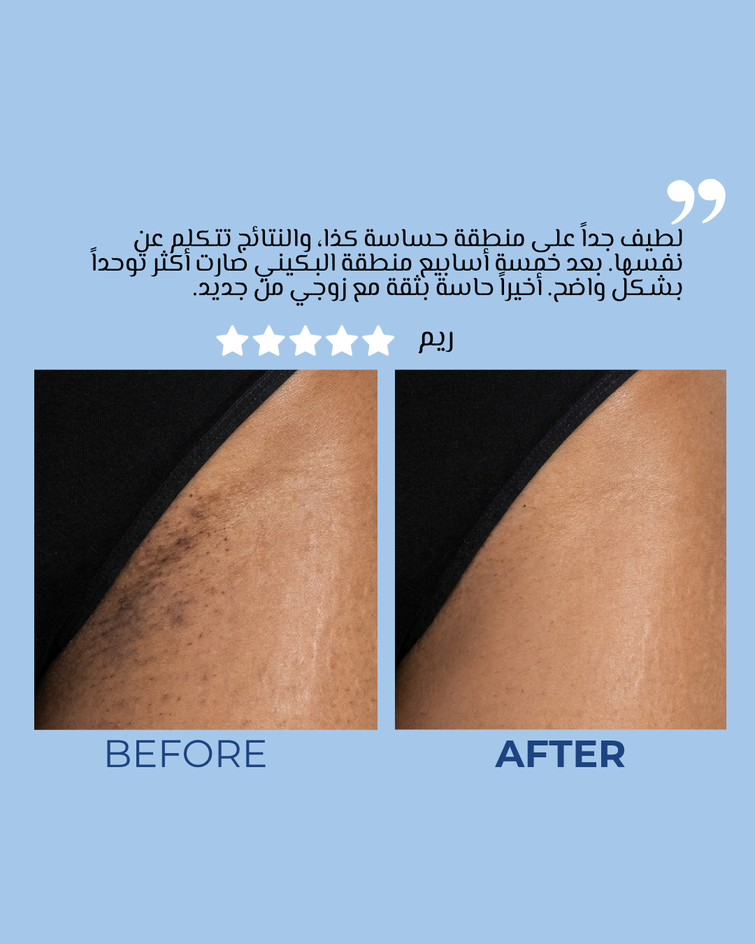 Feel Confident in Every Intimate Moment With Your Husband — No More Dark Intimate Areas