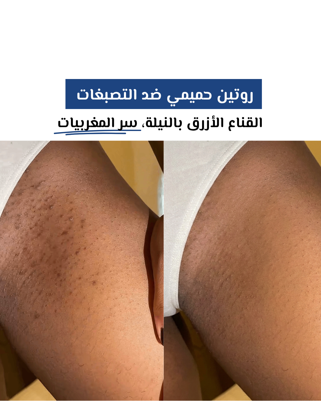 Feel Confident in Every Intimate Moment With Your Husband — No More Dark Intimate Areas